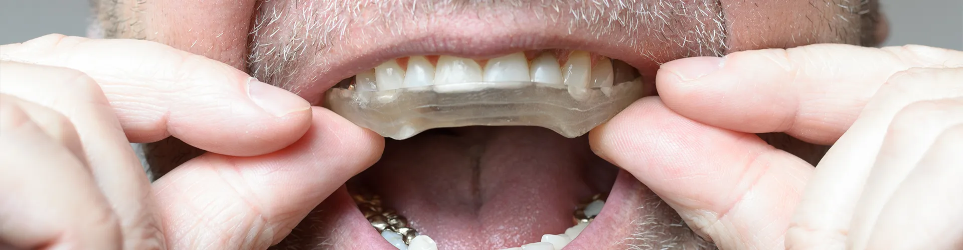 male placing bite plate in mouth