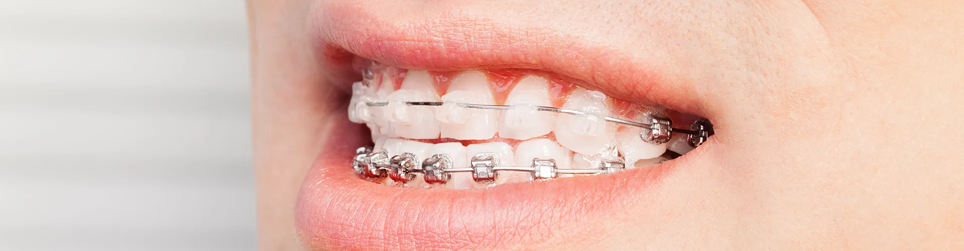 person smiling with clear braces on top teeth and metal braces on bottom teeth