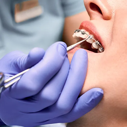 gloved handing applying rubberband to braces with dental tool