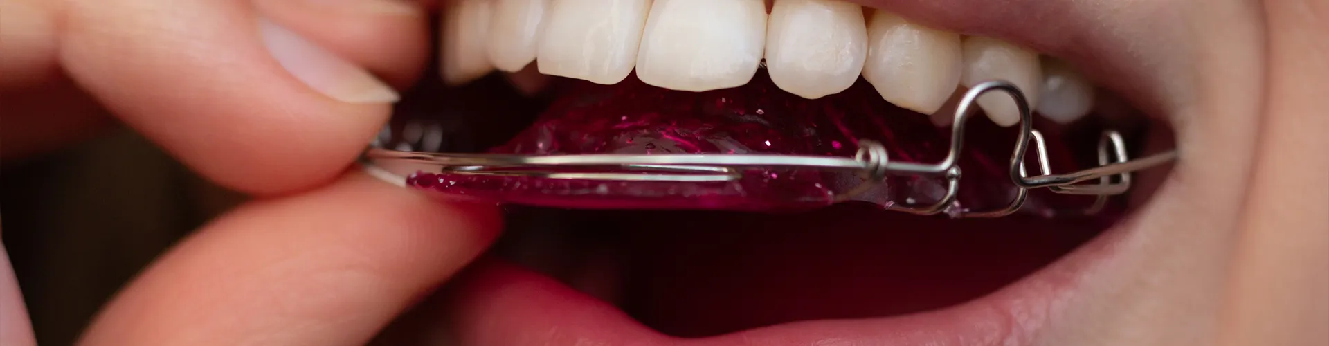 woman putting a retainer in her mouth