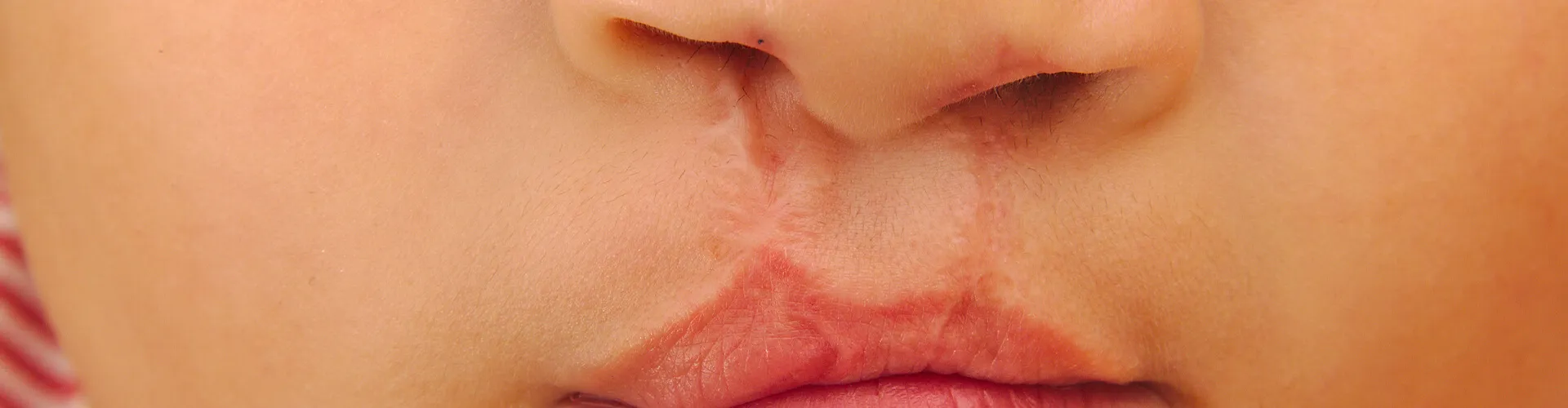 close view of child with a cleft palate