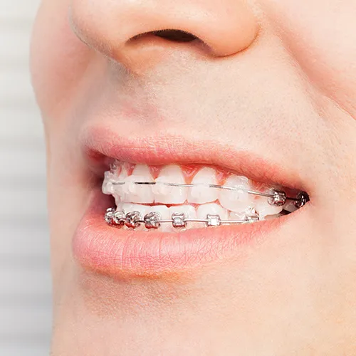 person smiling with clear braces on top teeth and metal braces on bottom teeth